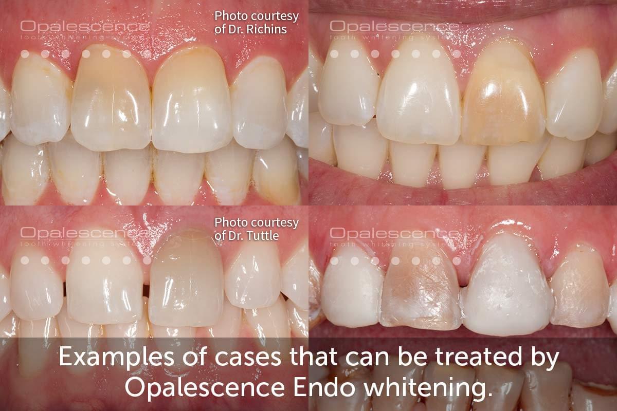 Dental Crown versus Dental Veneer