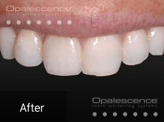 After using Opalescence Endo