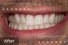 After using Opalescence Endo
