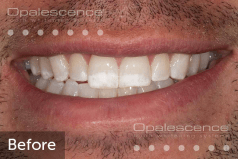 Before using Opalescence Endo