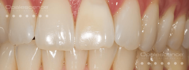 After Opalescence tooth whitening system