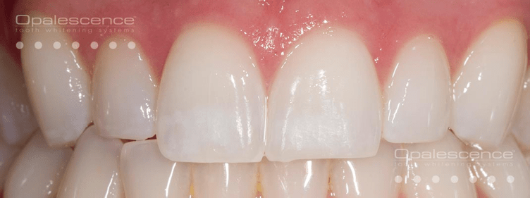 After Opalescence tooth whitening system