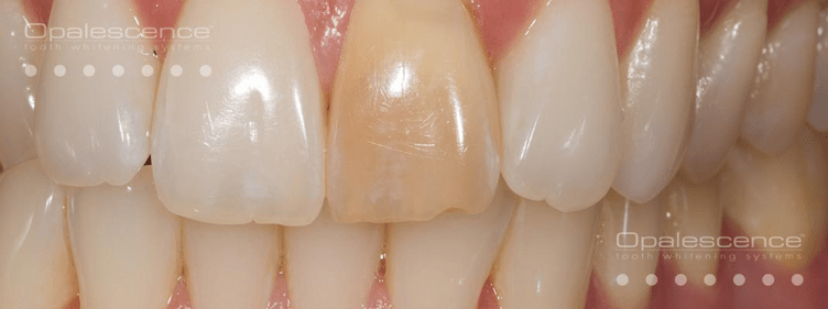Before Opalescence tooth whitening system