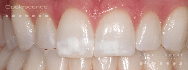 Before Opalescence tooth whitening system